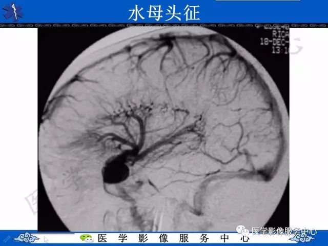 影像PPT - 水母头征-8