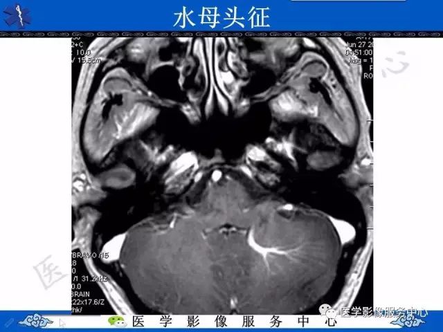 影像PPT - 水母头征-3