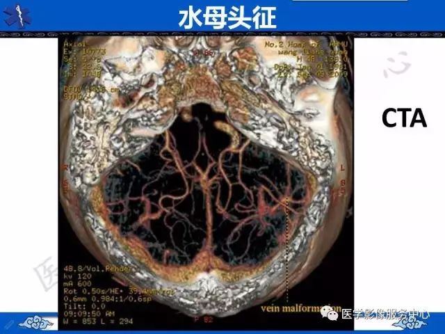 影像PPT - 水母头征-10
