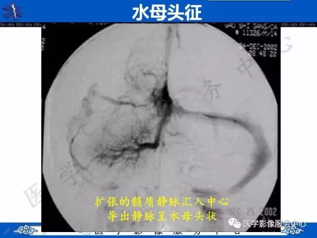 影像PPT - 水母头征-2