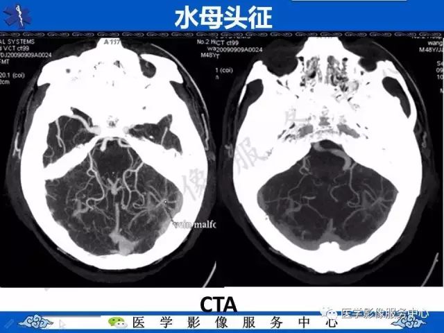 影像PPT - 水母头征-9