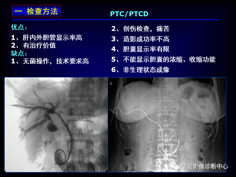 影像PPT - 【病例】坏死性胆囊炎1例MR影像-18