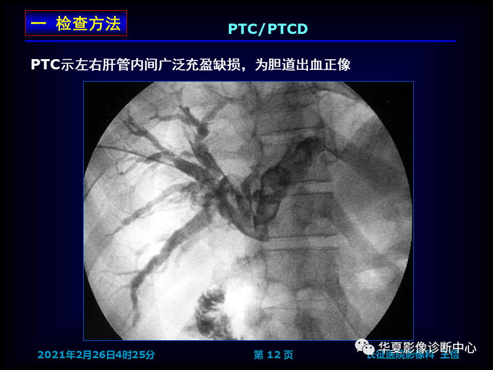 影像PPT - 【病例】坏死性胆囊炎1例MR影像-20