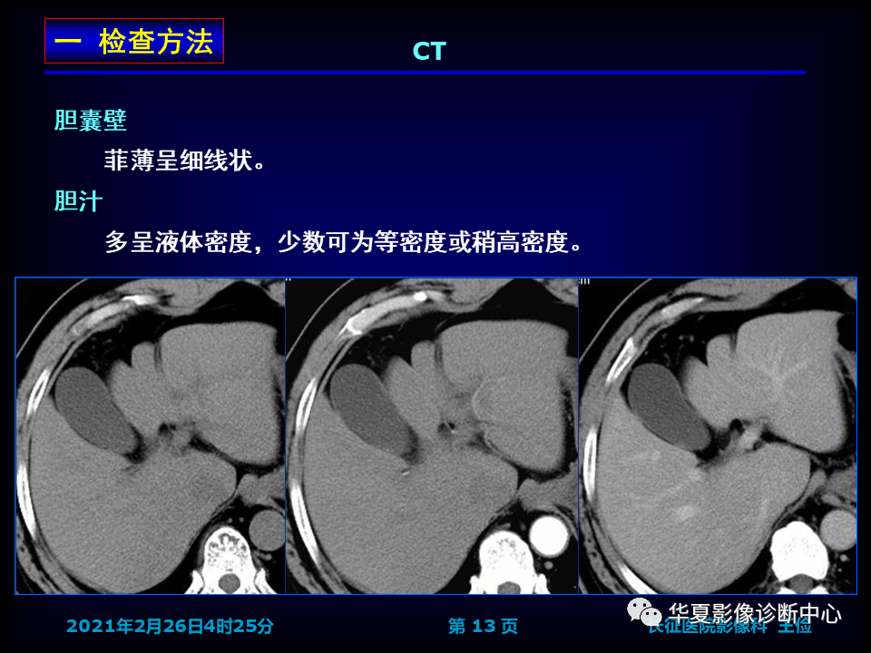 影像PPT - 【病例】坏死性胆囊炎1例MR影像-21