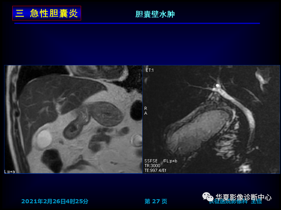 影像PPT - 【病例】坏死性胆囊炎1例MR影像-34