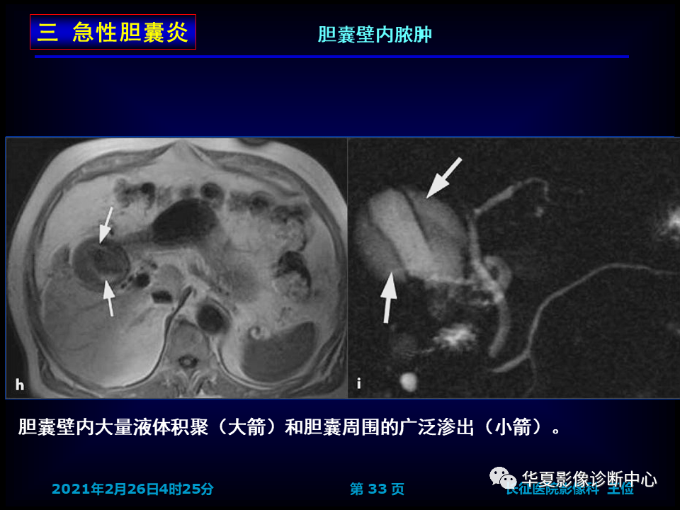 影像PPT - 【病例】坏死性胆囊炎1例MR影像-40