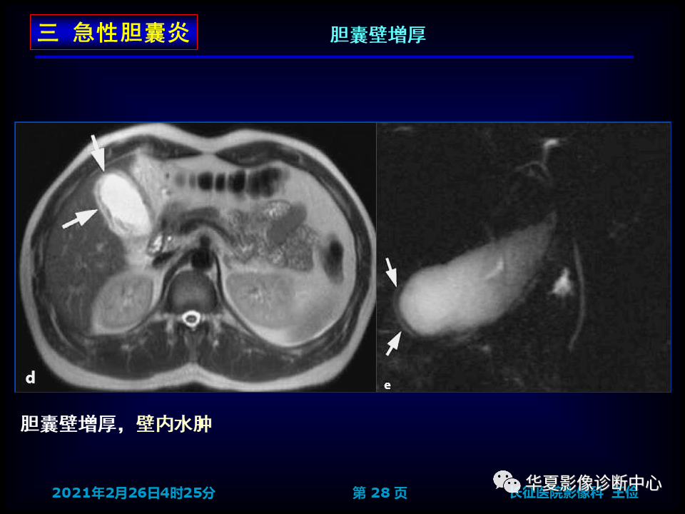 影像PPT - 【病例】坏死性胆囊炎1例MR影像-35