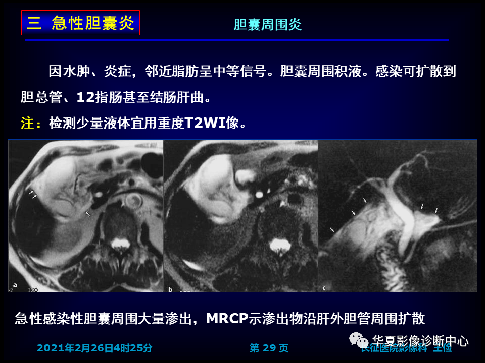 影像PPT - 【病例】坏死性胆囊炎1例MR影像-36