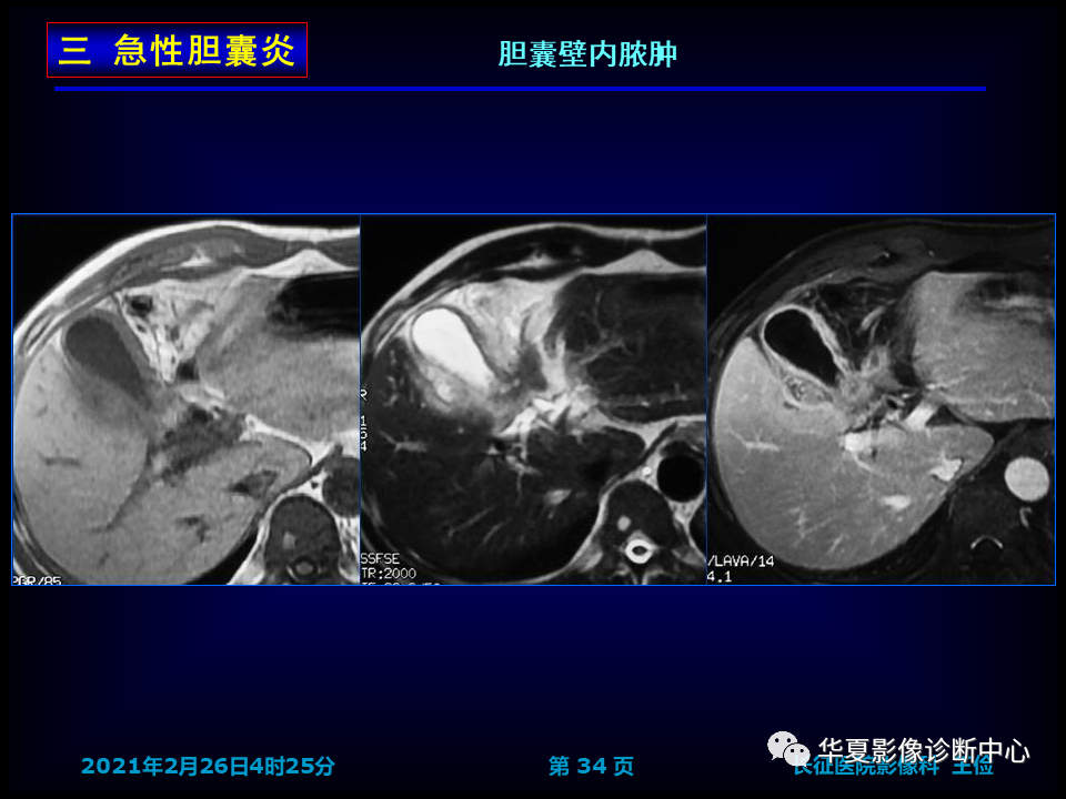 影像PPT - 【病例】坏死性胆囊炎1例MR影像-41
