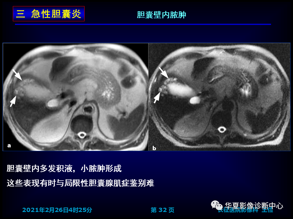 影像PPT - 【病例】坏死性胆囊炎1例MR影像-39