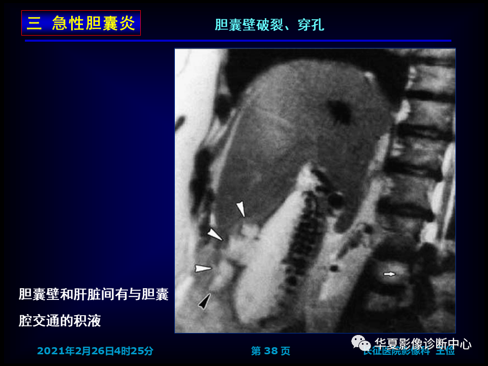 影像PPT - 【病例】坏死性胆囊炎1例MR影像-45