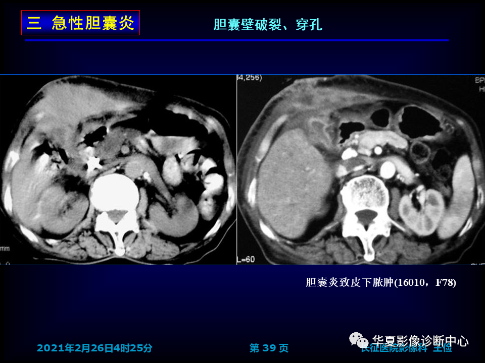 影像PPT - 【病例】坏死性胆囊炎1例MR影像-46
