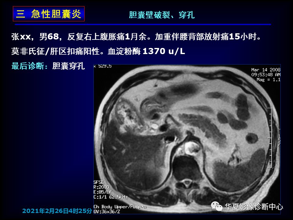 影像PPT - 【病例】坏死性胆囊炎1例MR影像-47