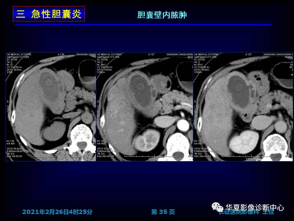 影像PPT - 【病例】坏死性胆囊炎1例MR影像-42