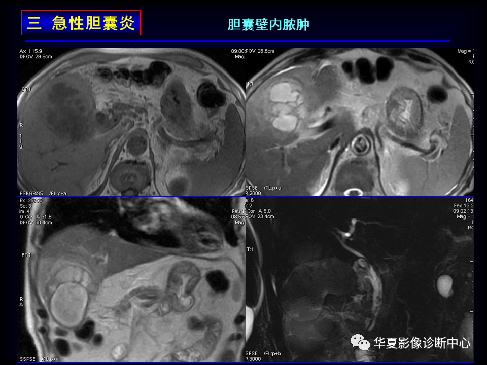 影像PPT - 【病例】坏死性胆囊炎1例MR影像-43