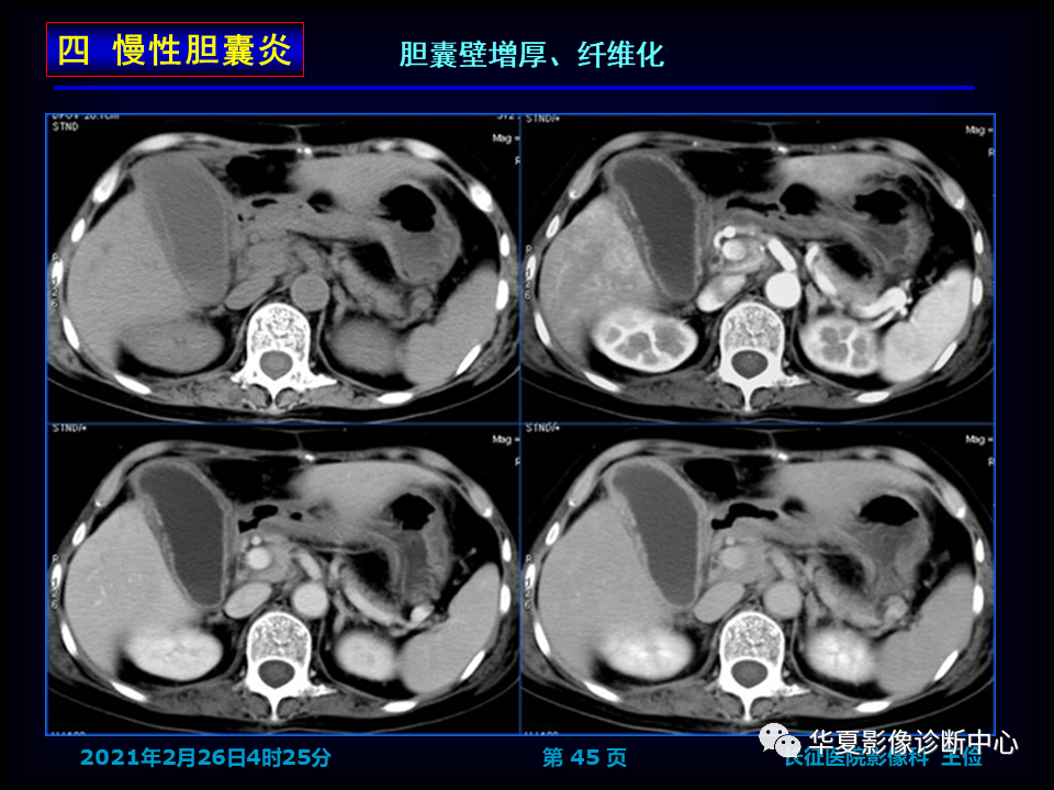 影像PPT - 【病例】坏死性胆囊炎1例MR影像-52