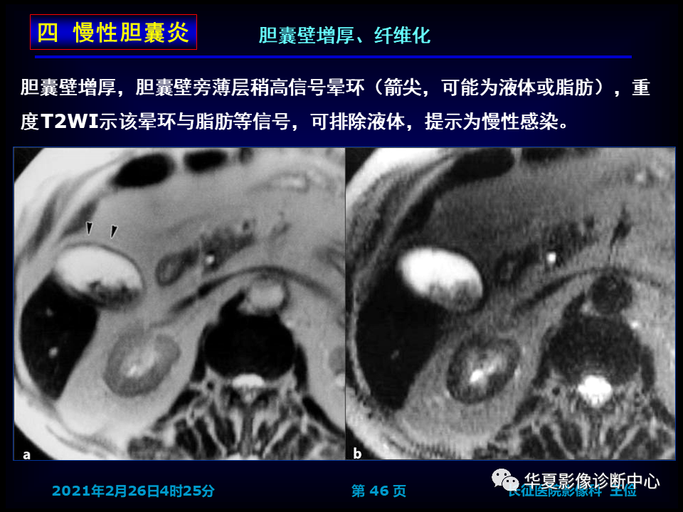 影像PPT - 【病例】坏死性胆囊炎1例MR影像-53