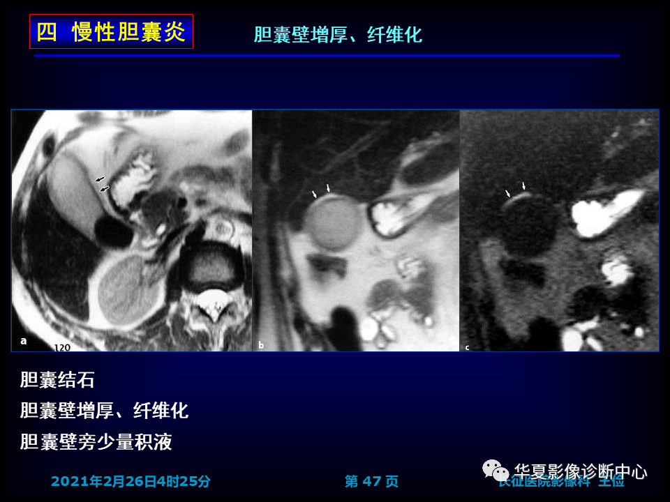 影像PPT - 【病例】坏死性胆囊炎1例MR影像-54