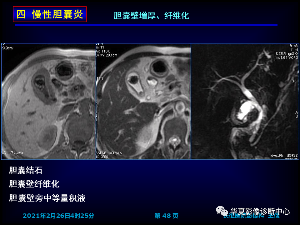 影像PPT - 【病例】坏死性胆囊炎1例MR影像-55