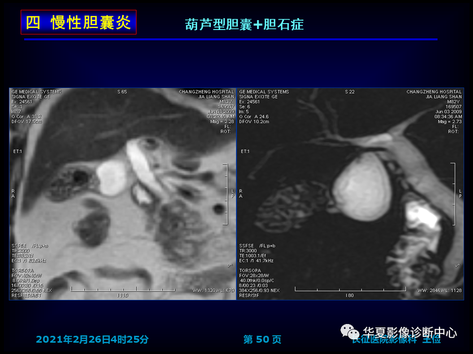 影像PPT - 【病例】坏死性胆囊炎1例MR影像-57