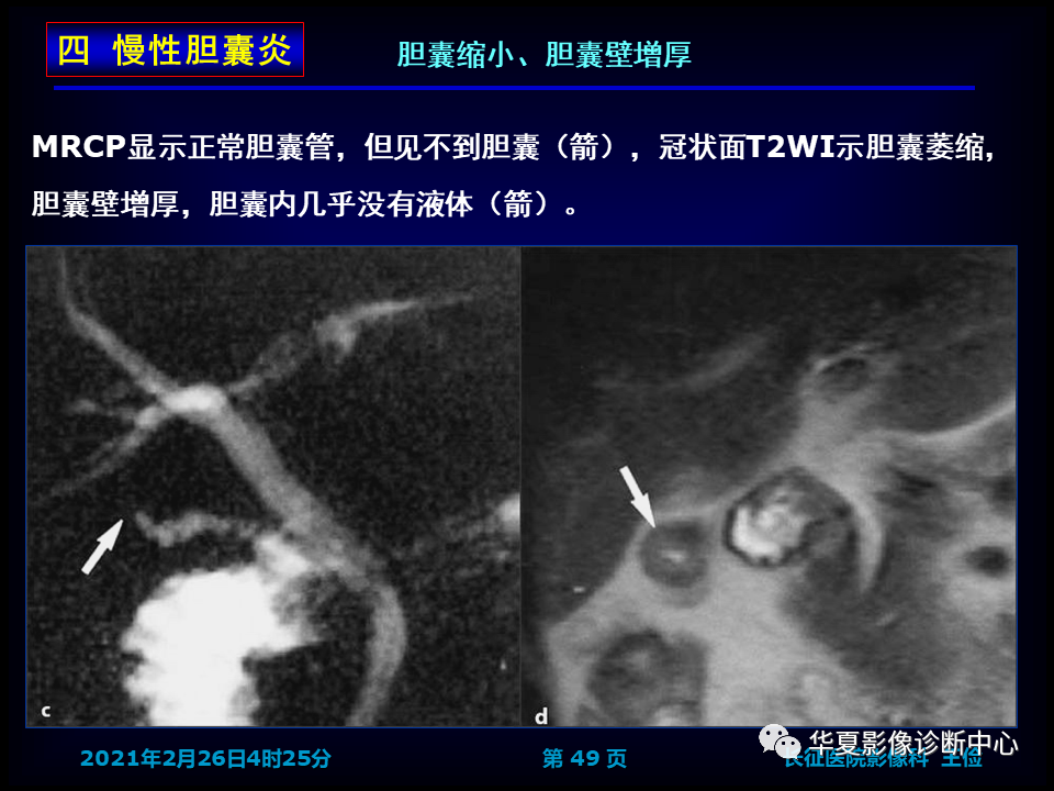 影像PPT - 【病例】坏死性胆囊炎1例MR影像-56
