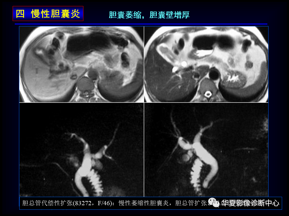 影像PPT - 【病例】坏死性胆囊炎1例MR影像-59