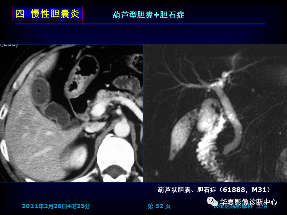 影像PPT - 【病例】坏死性胆囊炎1例MR影像-58