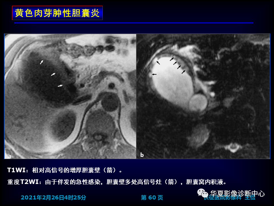 影像PPT - 【病例】坏死性胆囊炎1例MR影像-66