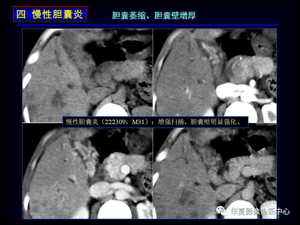 影像PPT - 【病例】坏死性胆囊炎1例MR影像-60