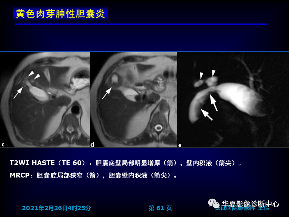 影像PPT - 【病例】坏死性胆囊炎1例MR影像-67