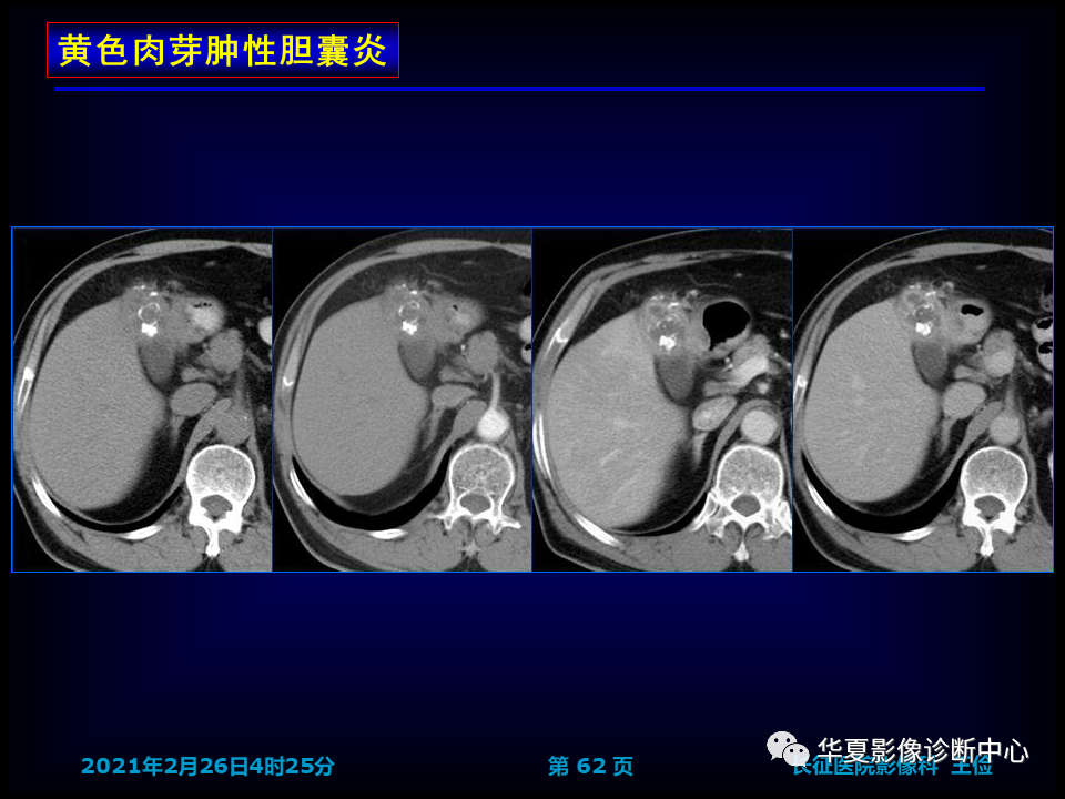 影像PPT - 【病例】坏死性胆囊炎1例MR影像-68