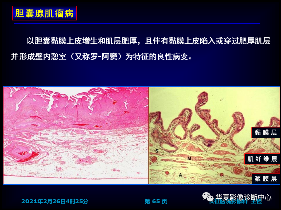 影像PPT - 【病例】坏死性胆囊炎1例MR影像-71