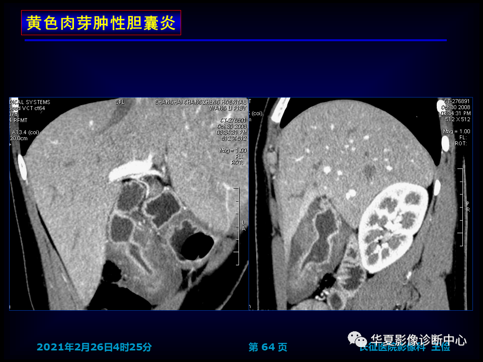 影像PPT - 【病例】坏死性胆囊炎1例MR影像-70
