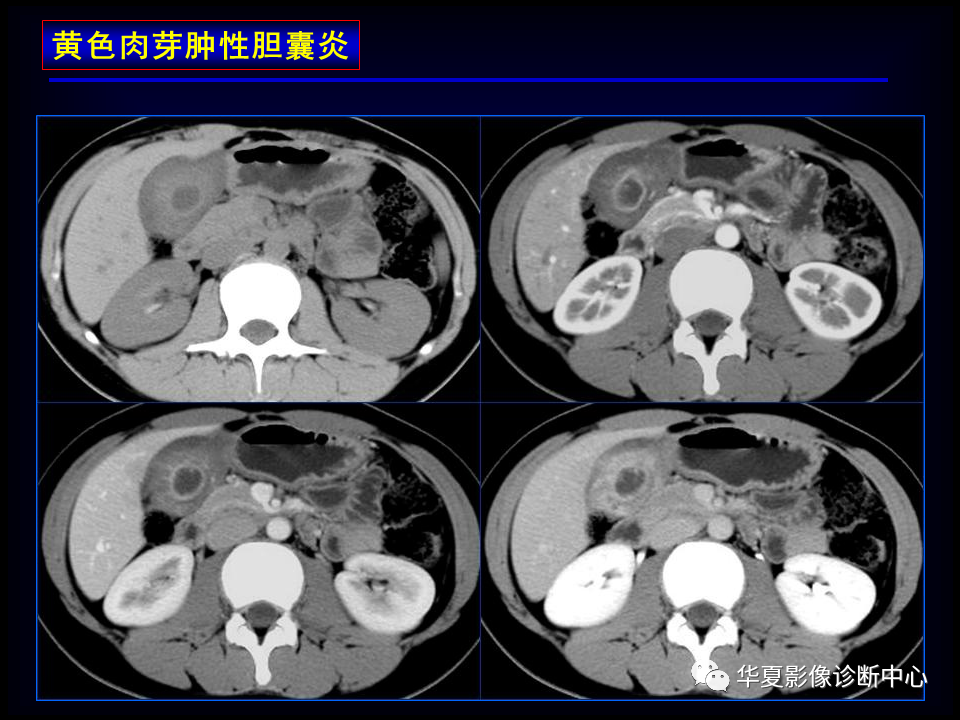 影像PPT - 【病例】坏死性胆囊炎1例MR影像-69