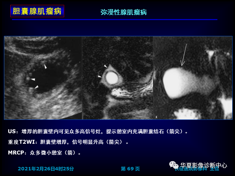 影像PPT - 【病例】坏死性胆囊炎1例MR影像-76