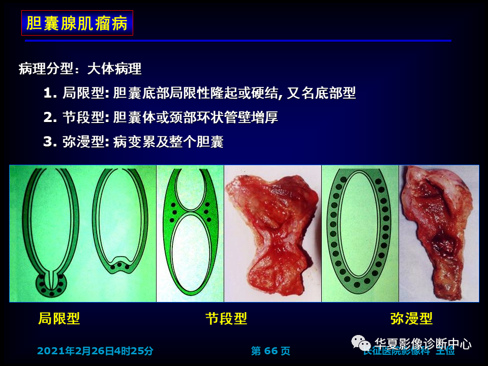 影像PPT - 【病例】坏死性胆囊炎1例MR影像-73