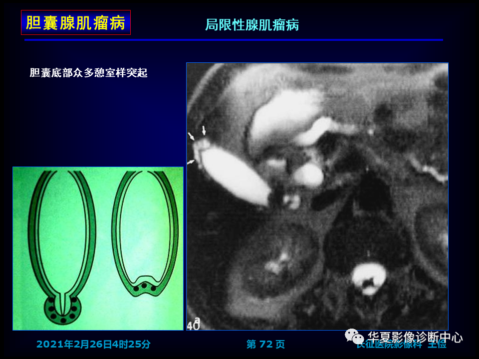 影像PPT - 【病例】坏死性胆囊炎1例MR影像-79
