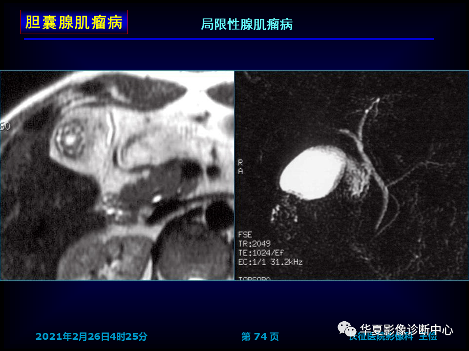 影像PPT - 【病例】坏死性胆囊炎1例MR影像-81