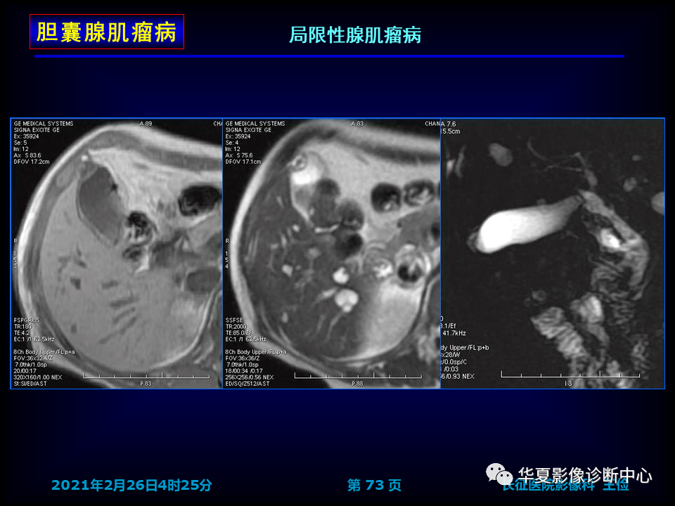 影像PPT - 【病例】坏死性胆囊炎1例MR影像-80