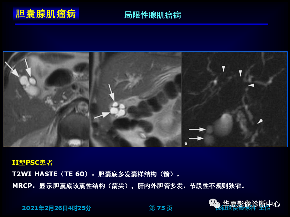 影像PPT - 【病例】坏死性胆囊炎1例MR影像-82