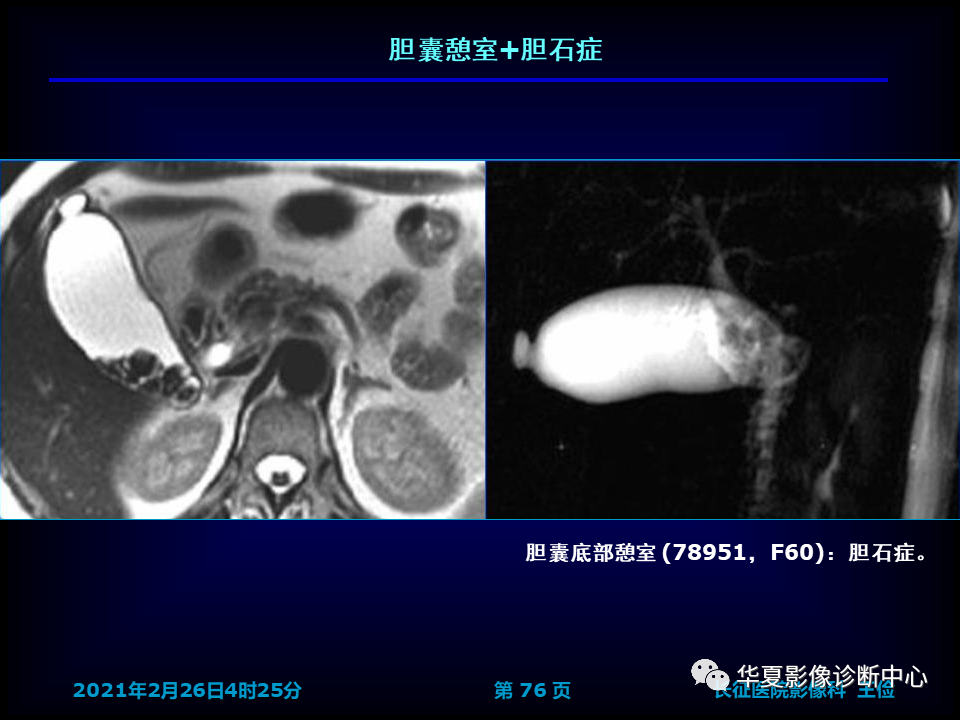 影像PPT - 【病例】坏死性胆囊炎1例MR影像-83