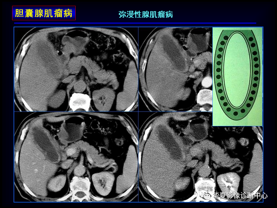 影像PPT - 【病例】坏死性胆囊炎1例MR影像-77