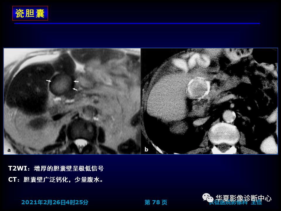 影像PPT - 【病例】坏死性胆囊炎1例MR影像-85
