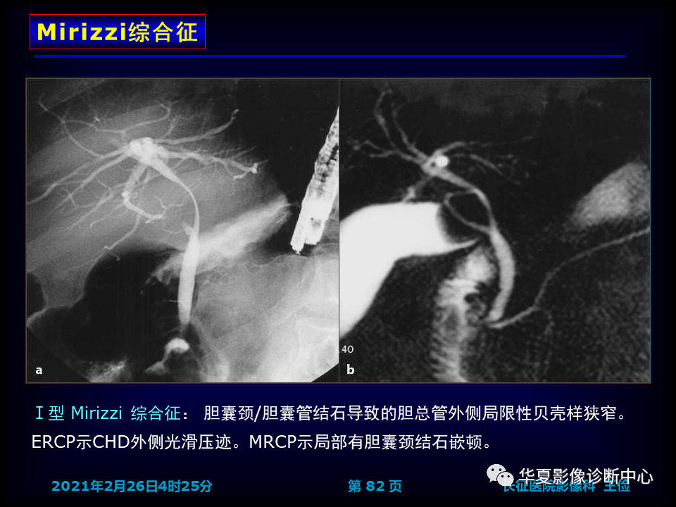影像PPT - 【病例】坏死性胆囊炎1例MR影像-89