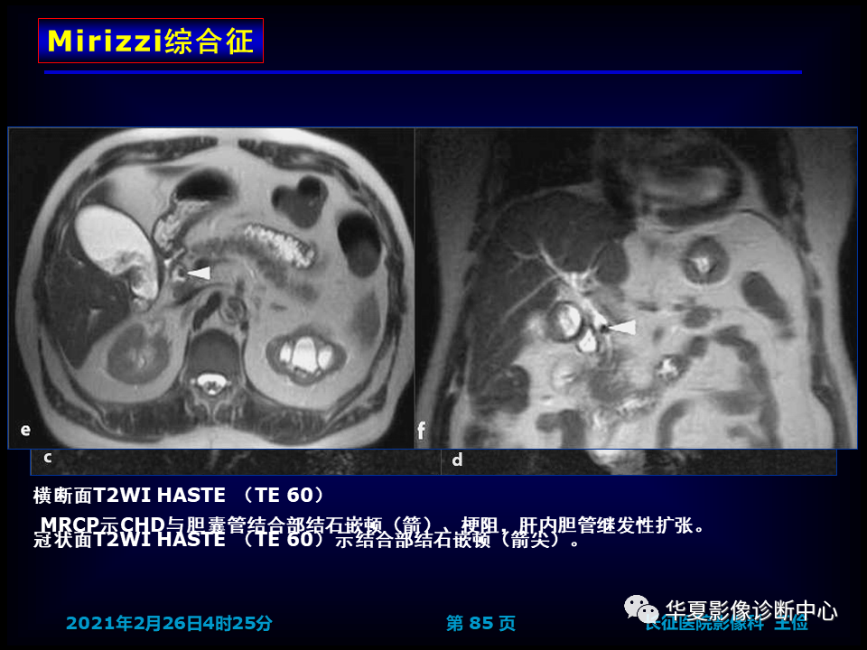 影像PPT - 【病例】坏死性胆囊炎1例MR影像-92