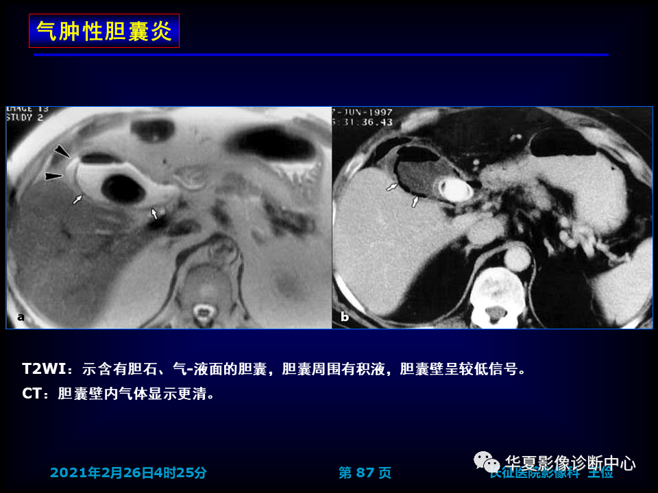 影像PPT - 【病例】坏死性胆囊炎1例MR影像-94