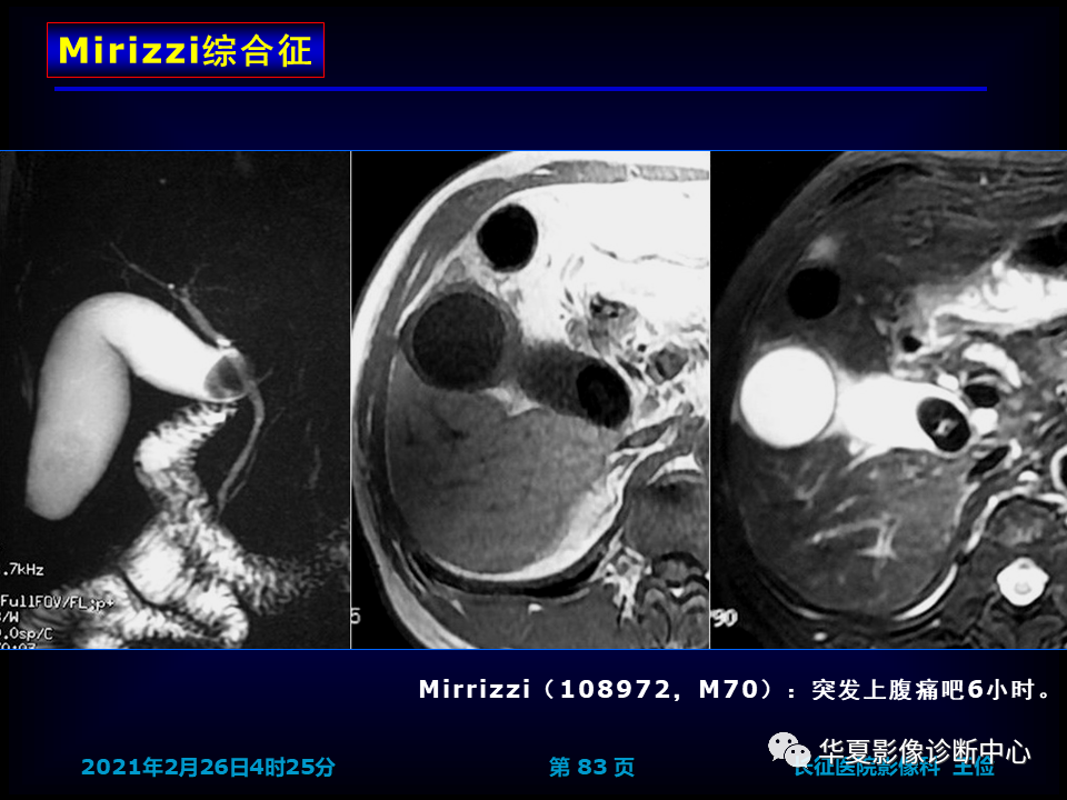 影像PPT - 【病例】坏死性胆囊炎1例MR影像-90