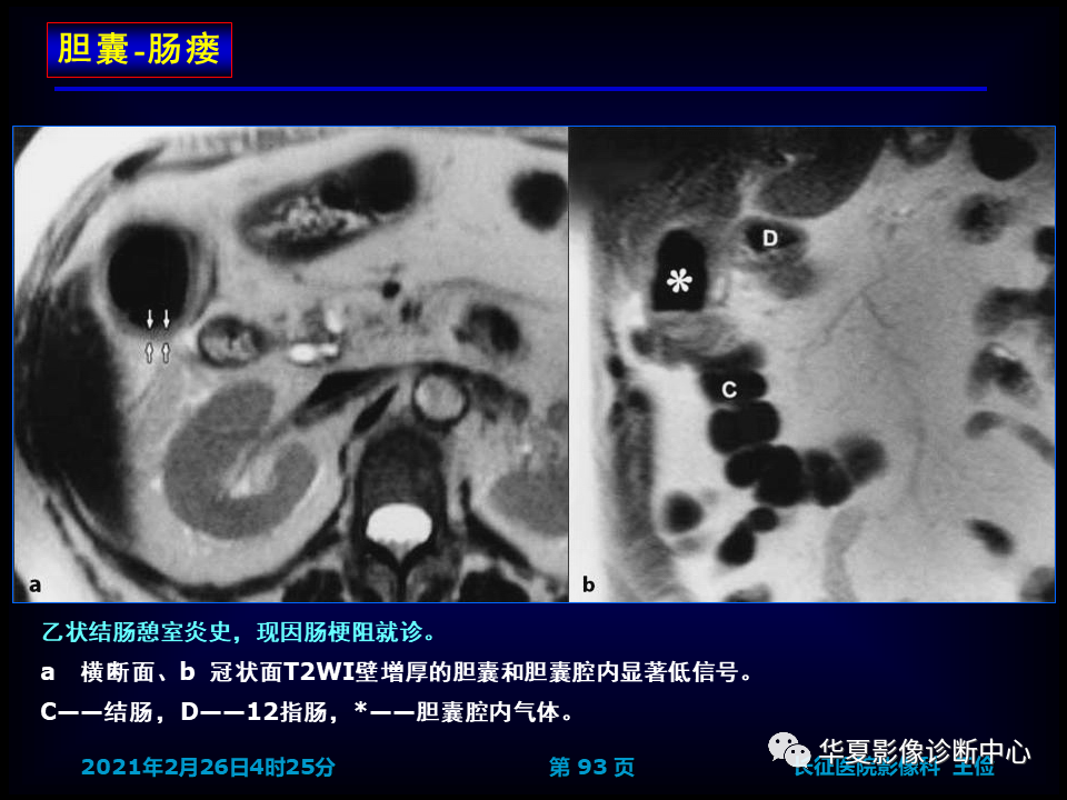 影像PPT - 【病例】坏死性胆囊炎1例MR影像-99