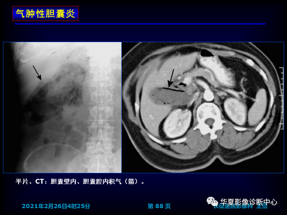 影像PPT - 【病例】坏死性胆囊炎1例MR影像-95