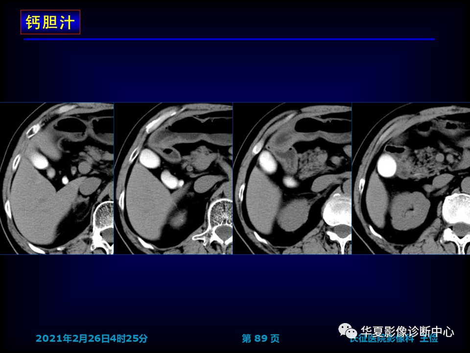 影像PPT - 【病例】坏死性胆囊炎1例MR影像-96